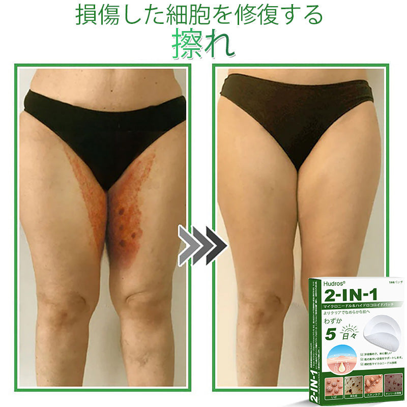 𝐇𝐮𝐝𝐫𝐨𝐬® 👑 𝟐-𝐢𝐧-𝟏 ハイドロコロイドマイクロニードルパッチ｜盛り上がったほくろ、ニキビ、平らなイボおよび皮膚の突起の除去用に特別設計｜𝟏𝟒𝟒枚入りパッケージ❄️